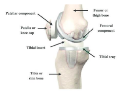 Exactech Recall Knee Device